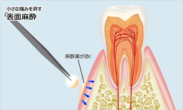 当院の麻酔における工夫