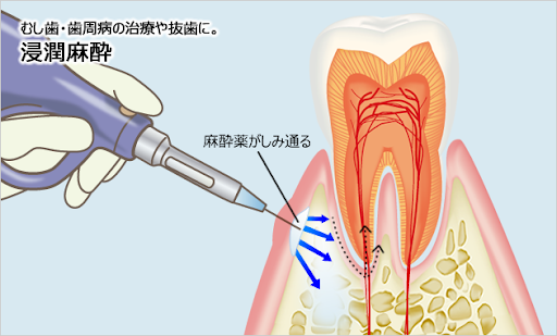 当院の麻酔における工夫