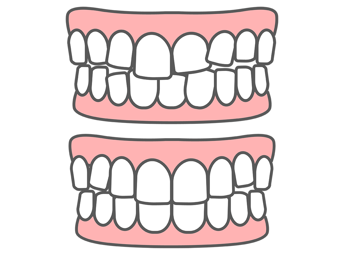 叢生（歯のデコボコ）