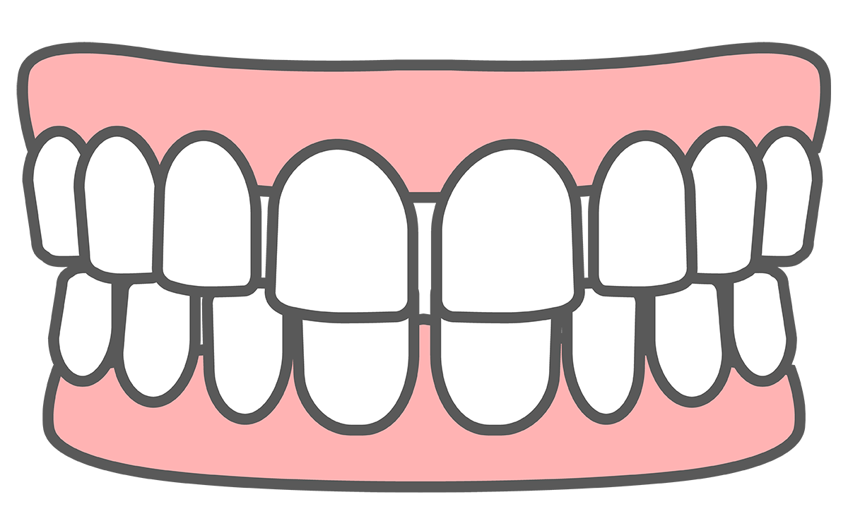 空隙歯列（すきっ歯）