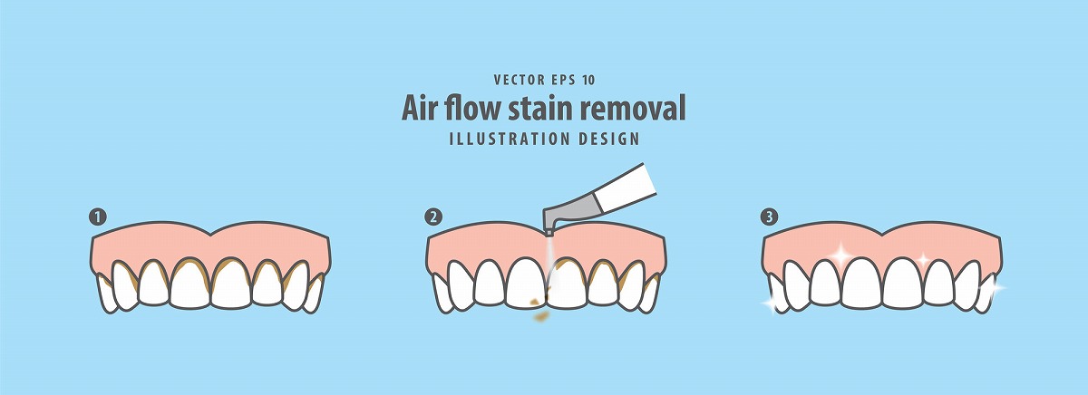 エアフローを用いた歯垢や着色の除去