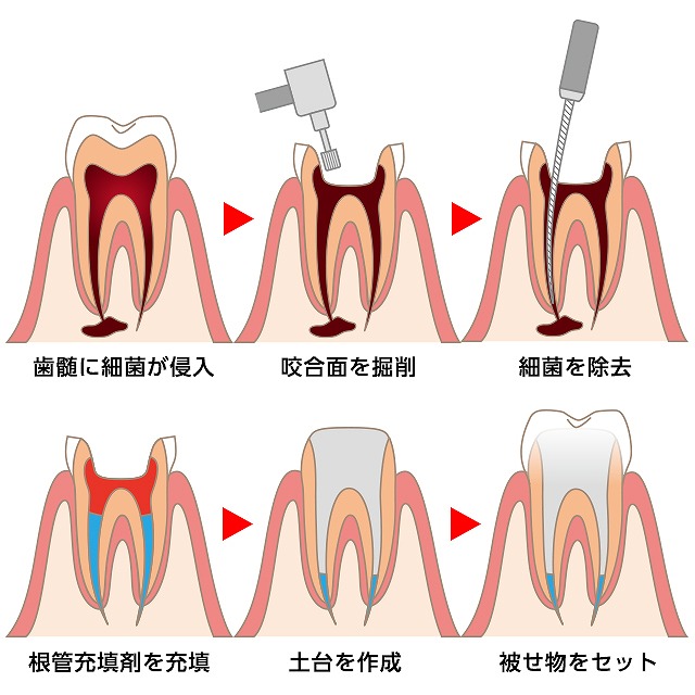 歯を残すための根管治療